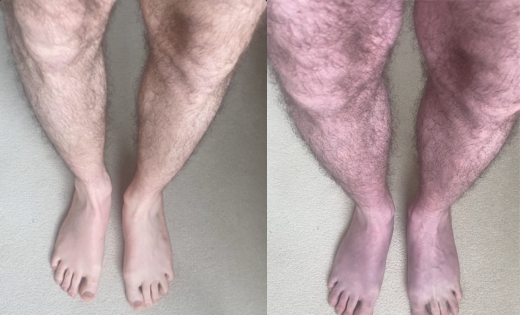 Raising awareness of Long Covid ‘blue legs’ symptom, August 2023